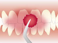 STEP1 プラークの染め出し