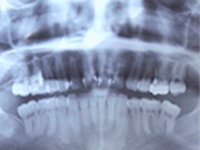STEP1 診査・診断（レントゲン撮影）