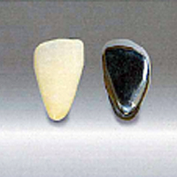 硬質レジン前装冠