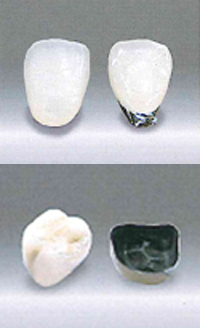 メタルボンドクラウン