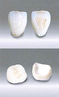 ホワイトジルコニアクラウン