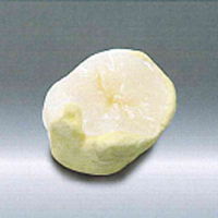 オールセラミックスインレー